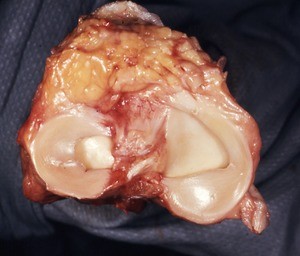 Natural color photograph of dissection of the left knee, showing the superior surface of the tibia, with the medial and lateral meniscus intact