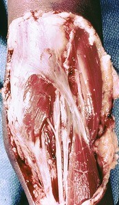 Natural color photograph of dissection of the cubital fossa, anterior view, showing the median and ulnar nerves medial to the biceps brachii muscle