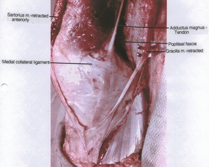 Natural color photgraph of right knee, anteromedial view, showing muscle, ligament and tendon with the Sartorius and Gracilis muscles retracted