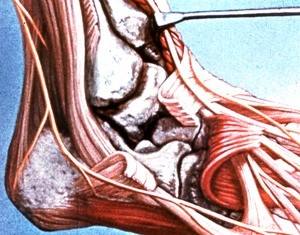 Illustration of wider exposure of structures of right talocrural joint, lateral view