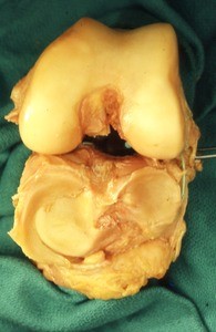 Natural color photograph of dissection of the left knee, showing the inferior and superior aspects of the knee joint