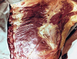 Natural color photograph of dissection of the right side of the back, posterior view, with the trapezius muscle removed to expose the underlying muscle layers