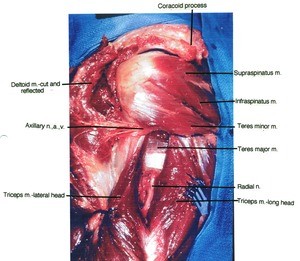 Natural color photograph of dissection of the left shoulder, lateral view, showing muscles and nerves with the deltoid muscle retracted to expose the rotator cuff