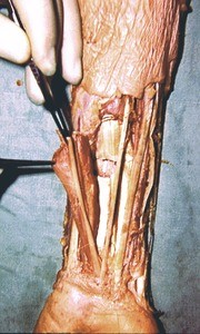 Natural color photograph of dissection of the left forearm, anterior view