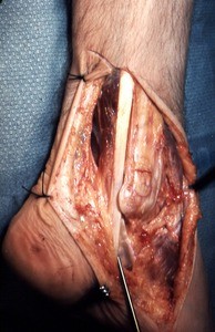 Natural color photograph of dissection of the right ankle, lateral view