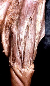 Natural color photograph of dissection of the cubital fossa