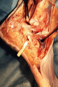 Natural color photograph of dissection of the right foot, lateral view, with the peroneus longus t. cut