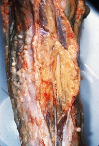 Natural color photograph of superficial dissection of the popliteal fossa