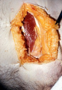 Natural color photograph of the inguinal region, anterior view