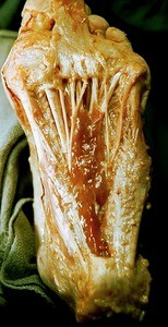 Natural color photograph of dissection of the plantar surface of the left foot