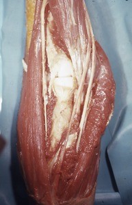 Natural color photograph of dissection of the right cubital fossa, anterior view, showing the head of the radius and its articulation with the capitulum of the humerus