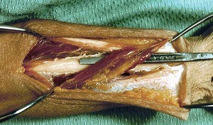 Natural color photograph of dissection of the forearm