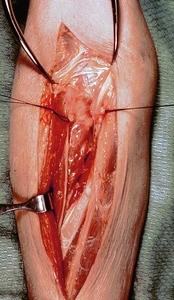 Natural color photograph of dissection of the forearm, anterior view