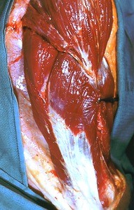 Natural color photograph of dissection of the right arm, lateral view