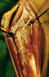 Natural color photograph of dissection of the forearm