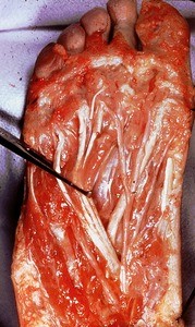 Natural color photograph of dissection of the plantar surface of the right foot