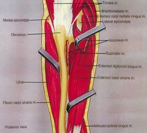 Illustration of dissection of the right forearm and elbow, posterior view, showing the superficial musculature with the anconeus muscle retracted laterally