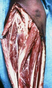 Natural color photograph of dissection of the forearm