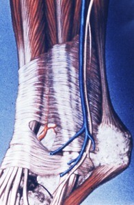 Illustration of superficial dissection of dorsolateral aspect of left ankle showing sural n., a., & v in relation to superior and inferior extensor retinacula