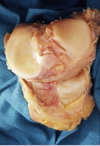 Natural color photograph of dissection of the knee joint, superior view, showing the articular surfaces of the tibia