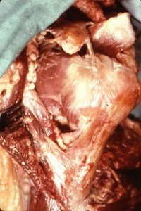 Natural color photograph of dissection of the left shoulder, anterior view, with the deltoid muscle reflected to show bone and muscle structure