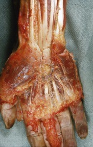 Natural color photograph of dissection of the right hand, anterior view