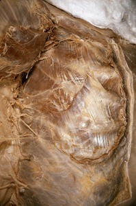 Natural color photograph of dissection of the right thorax, anterior view, with the pectoralis muscles reflected to expose the external intercostal muscles