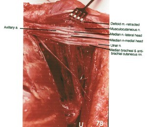 Natural color photograph of dissection of the brachial plexus, showing the major branches