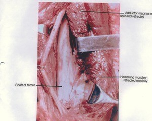 Natural color photograph of dissection of the femur, anterior view, with the adductor magnus muscle and hamstring muscles retracted medially