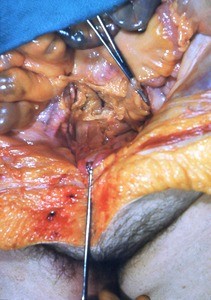 Natural color photograph of dissection of the lower abdomen, anterior view