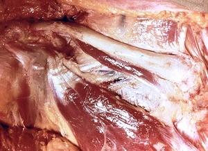 Natural color photograph of dissection of the thoracic wall, anterior view, showing the right clavicle and associated structures