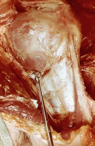 Natural color photograph of dissection of the right shoulder, anterior view, showing the head of the humerus and its associated