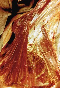 Natural color photograph of dissection of the left axilla, anterior view