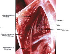 Natural color photograph of left knee, posteromedial view, showing nerves and muscles with the Bicep femoris retracted