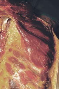 Natural color photograph of dissection of the right axilla, anterolateral view, showing the pectoralis muscles