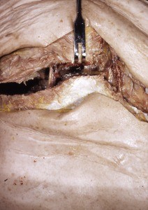 Natural color photograph of dissection of the thorax, anterior view, showing the sternum, which has been broken to begin exposing the mediastinum, internal thoracic arteries, and internal thoracic veins