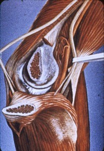 Iillustration of surgical exposure of osteotomy of medial epicondyle of humerus, left elbow radial nerve and median nerve indicated with forceps