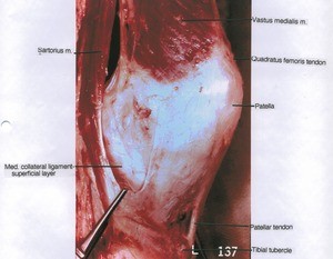 Natural color photograph of left knee, medial view, showing bone, tendons, muscles and ligament