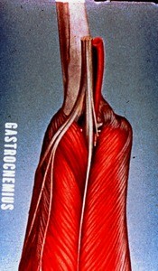 Illustration of gastrocnemius muscle's two bellies plus nerve-contents of lower half of popliteal fossa