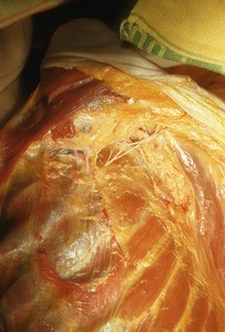 Natural color photograph of dissection of the upper left thorax, anterior view, with the skin removed to show musculature, nerves, and ribs