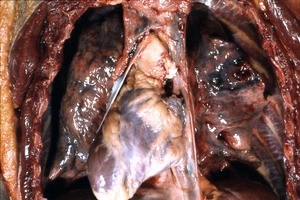 Natural color photograph of dissection of the thorax, anterior view, with the rib cage removed and and pericardium opened to reveal the heart and severed aorta