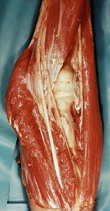 Natural color photograph of dissection of the left cubital fossa, anterior view, showing the head and neck of the radius, as well as the annular ligament