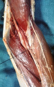 Natural color photograph of dissection of the left cubital fossa, anterior view