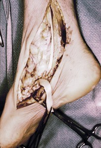 Natural color photograph of dissection of the right ankle, medial view, with the tibialis posterior t. cut and reflected