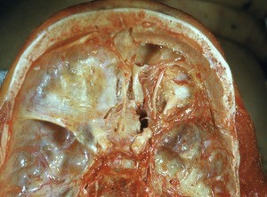 Natural color photograph of dissection of the anterior and middle cranial fossa, superior view, showing the superior surface of the right orbit