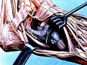 Illustration of dissection of deep exposure of right ankle joint, lateral view