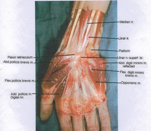 Natural color photograph of dissection of right wrist and hand, anterior view, showing artery, nerves, muscles and bone with the abductor digiti minimi muscle reflected