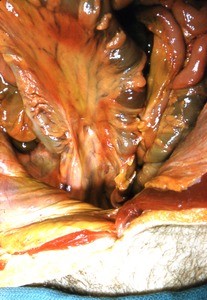 Natural color photograph of dissection of the peritoneal cavity, anterior view, showing abdominal viscera and associated mesentery