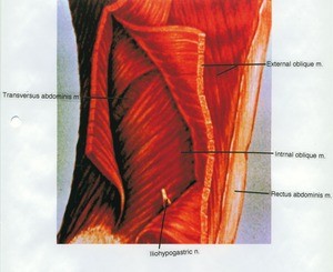 Illustration of dissection of the right abdominal muscles. The rectus sheath is removed, the external abdominal oblique is reflected and the iliohypogastric nerve is penetrating the internal abdominal oblique, lateral view