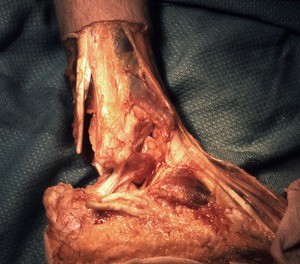 Natural color photograph of dissection of the right ankle, lateral view, showing muscles and tendons